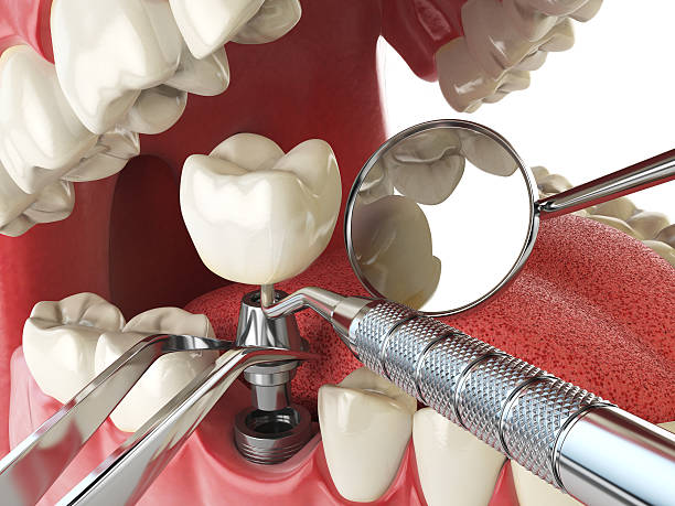 Best Emergency Tooth Extraction in East Glenville, NY